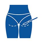 Buttock Augmentation